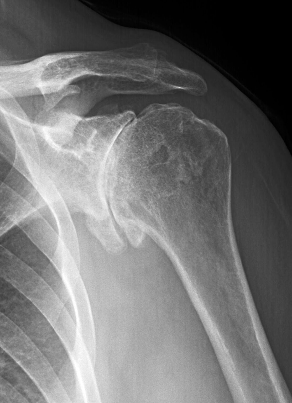 Shoulder Arthritis Dr Edward Weldon