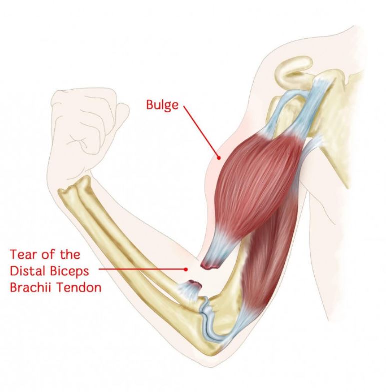 Distal Biceps Tendon Tear Dr Edward Weldon