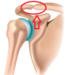 AC Joint Arthritis