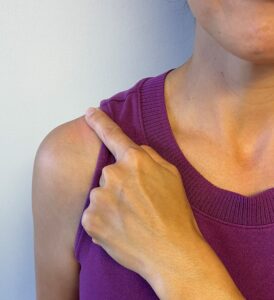 Acromioclavicular (AC) Joint Arthritis