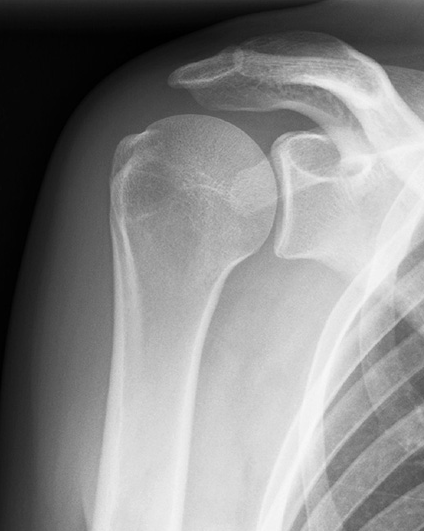 Broken bones of the shoulder – Dr. Edward Weldon