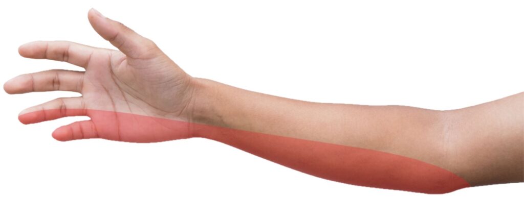 Ulnar Nerve Entrapment Novi, MI  Cubital Tunnel Syndrome Farmington Hills,  MI