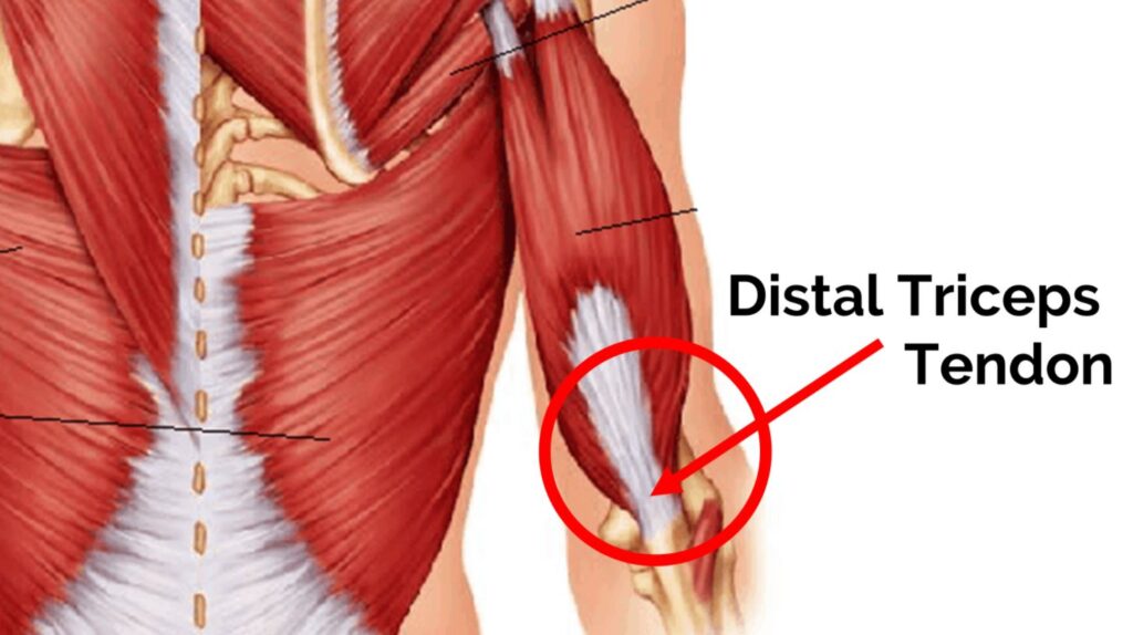 Distal Triceps Tendon Repair, Orthopedic Elbow Surgeon