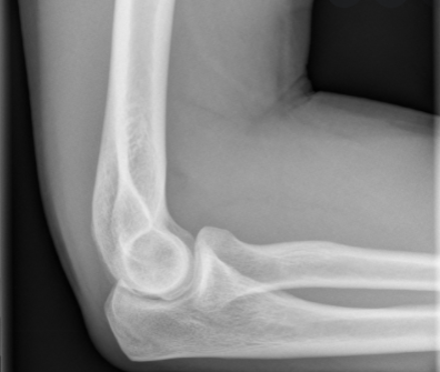 elbow normal xray