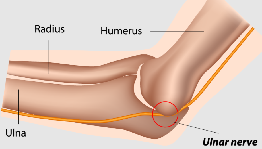 Cubital Tunnel Syndrome Salem, OR  Medial Epicondylectomy Corvallis, OR