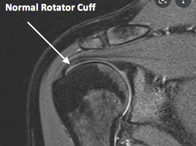 Mri Shoulder Bursitis