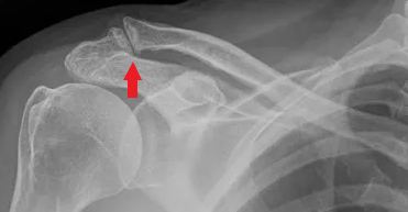 AC (acromioclavicular) Joint Resection for Arthritis – Dr. Edward Weldon