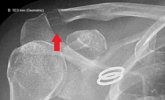 Acromioclavicular (AC) Joint Arthritis