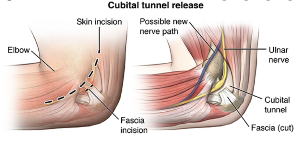 Cubital tunnel release – Dr. Edward Weldon