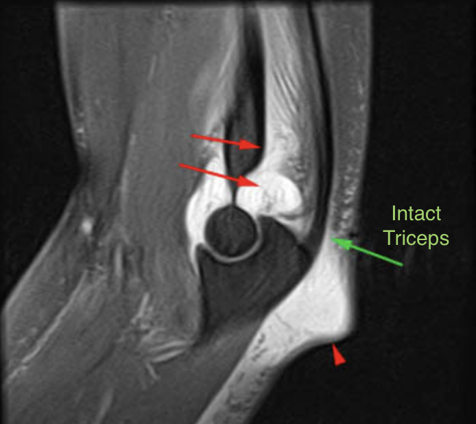 Triceps tendonitis causes and treatment