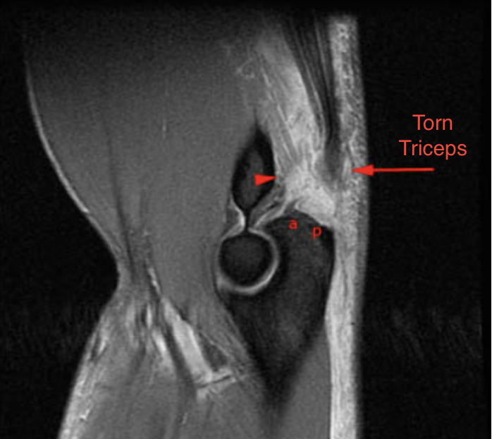 Triceps Tendon Tears – Dr. Edward Weldon