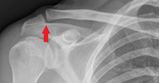 AC (acromioclavicular) Joint Resection for Arthritis – Dr. Edward Weldon