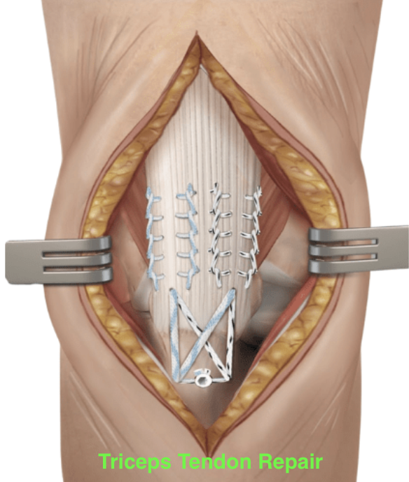 Triceps Tear Surgery – Dr. Edward Weldon