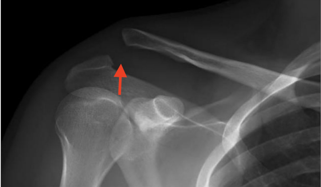 Acromioclavicular (AC) Joint Separations – Dr. Edward Weldon