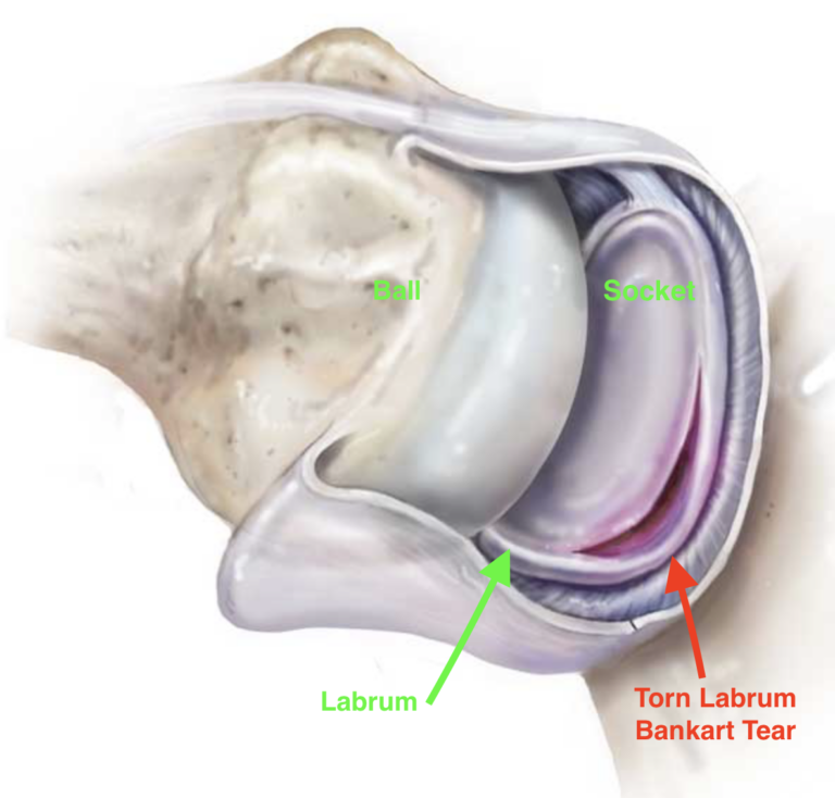 Surgery For The Dislocating Shoulder Bankart Repair Surgery Dr