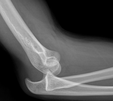 Elbow Dislocations – Dr. Edward Weldon