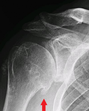 humeral bone spur2