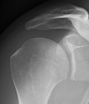 shoulder no bone spur